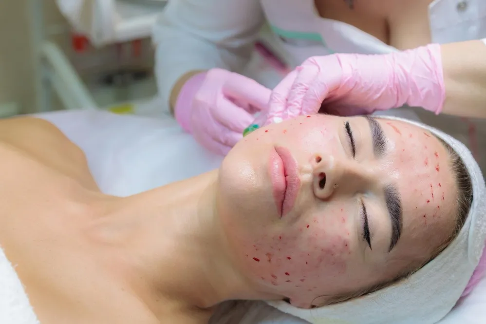 Vampire facial Chennai in Besant Nagar for full skin rejuvenation