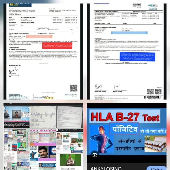 Ankylosing Spondilitis cured HLAb27 positive to negative by Dr Arpit Chopra Jain Aarpgya Super Spec...