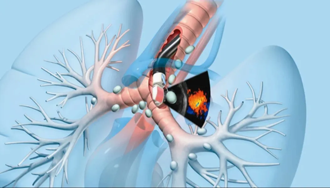 EBUS (Endobronchial Ultrasound) in Jaipur – Precision in Lung Diagnosis