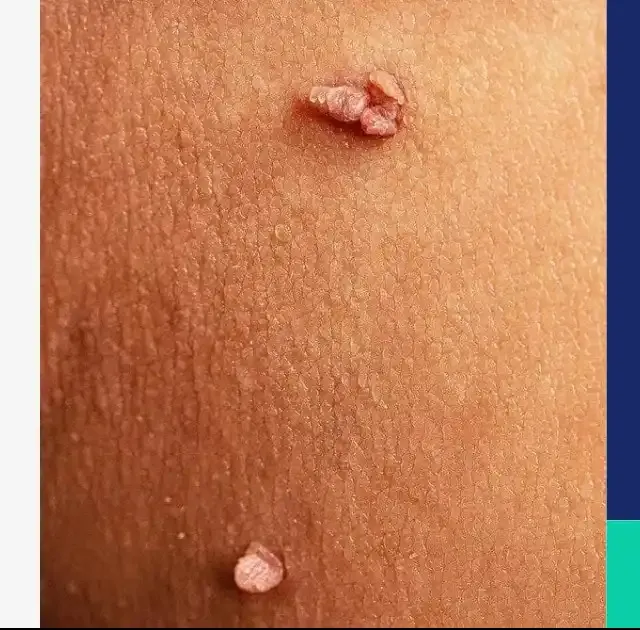 Gindodia Hospital: Advanced Genital Warts Treatment in Dhule
