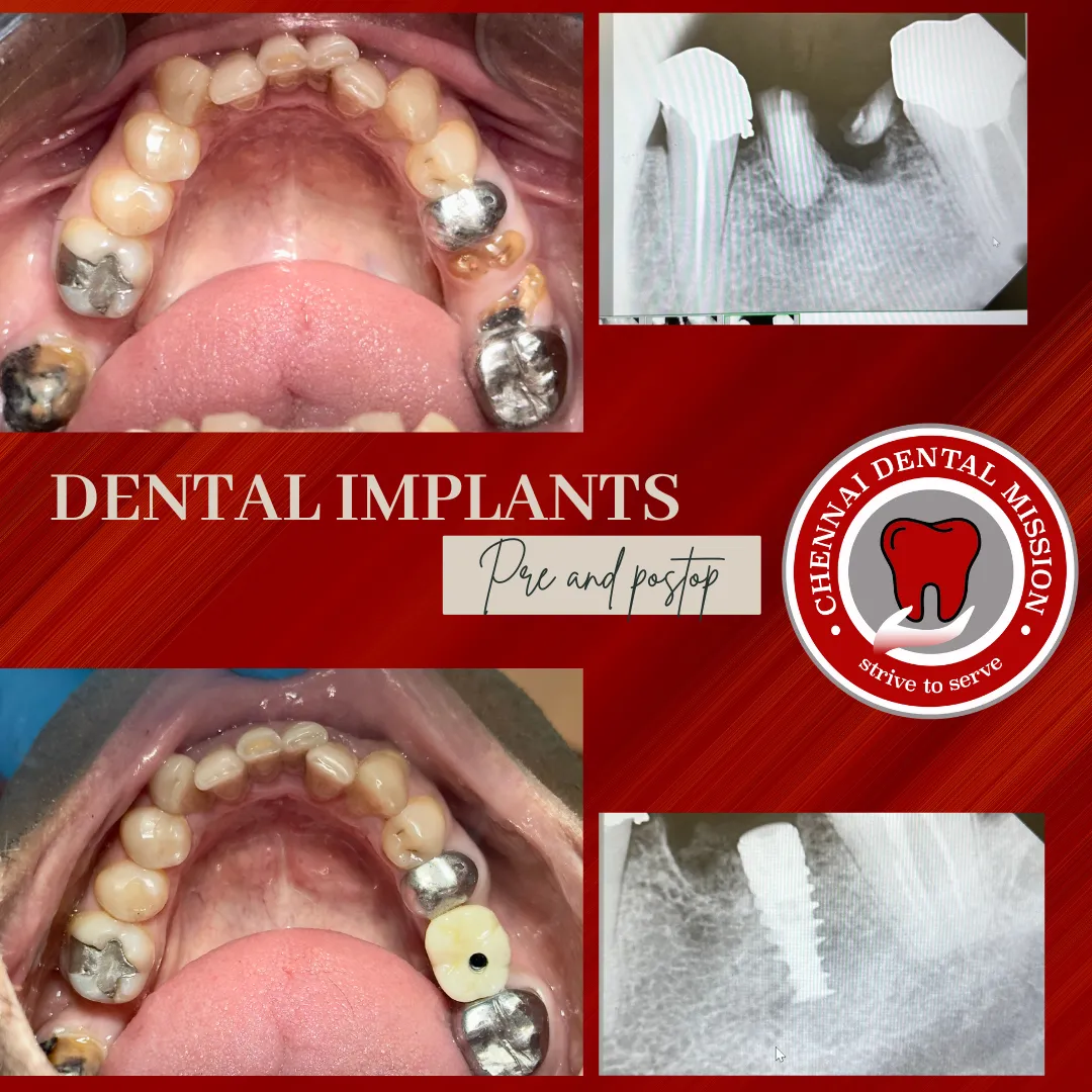 Dental Implants in Anna Nagar — Permanent Solution for Missing Teethe