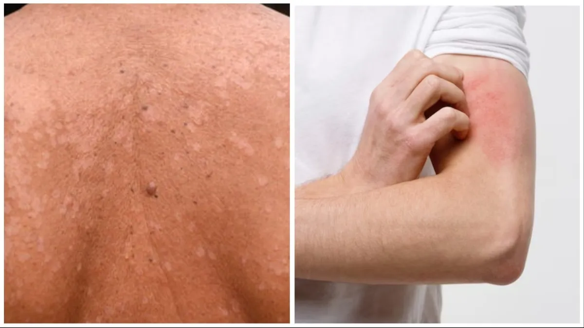 Gindodia Hospital: Advanced Tinea Versicolor Treatment in Dhule