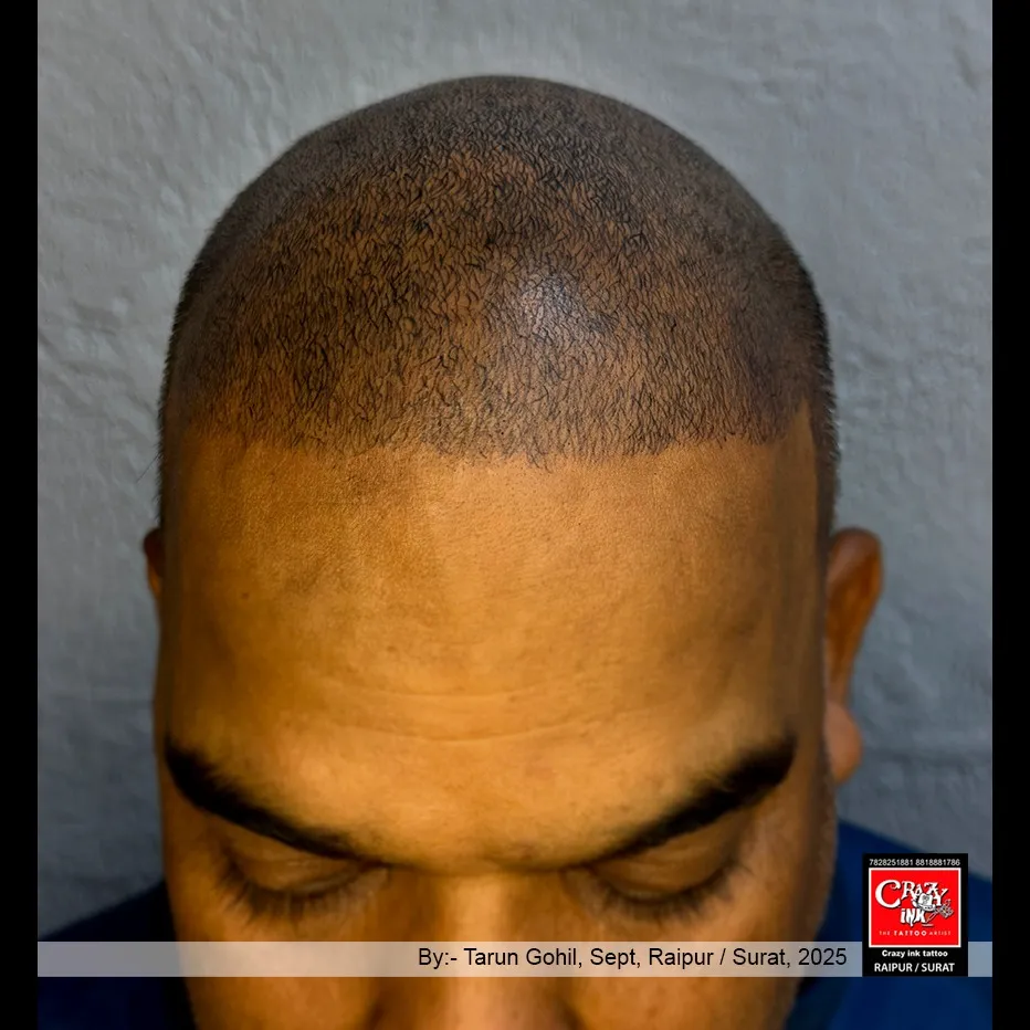 SCALP MICROPIGMENTATION (SMP) TRETMENT
This is a Scalp Micropigmentation (SMP) procedure d...