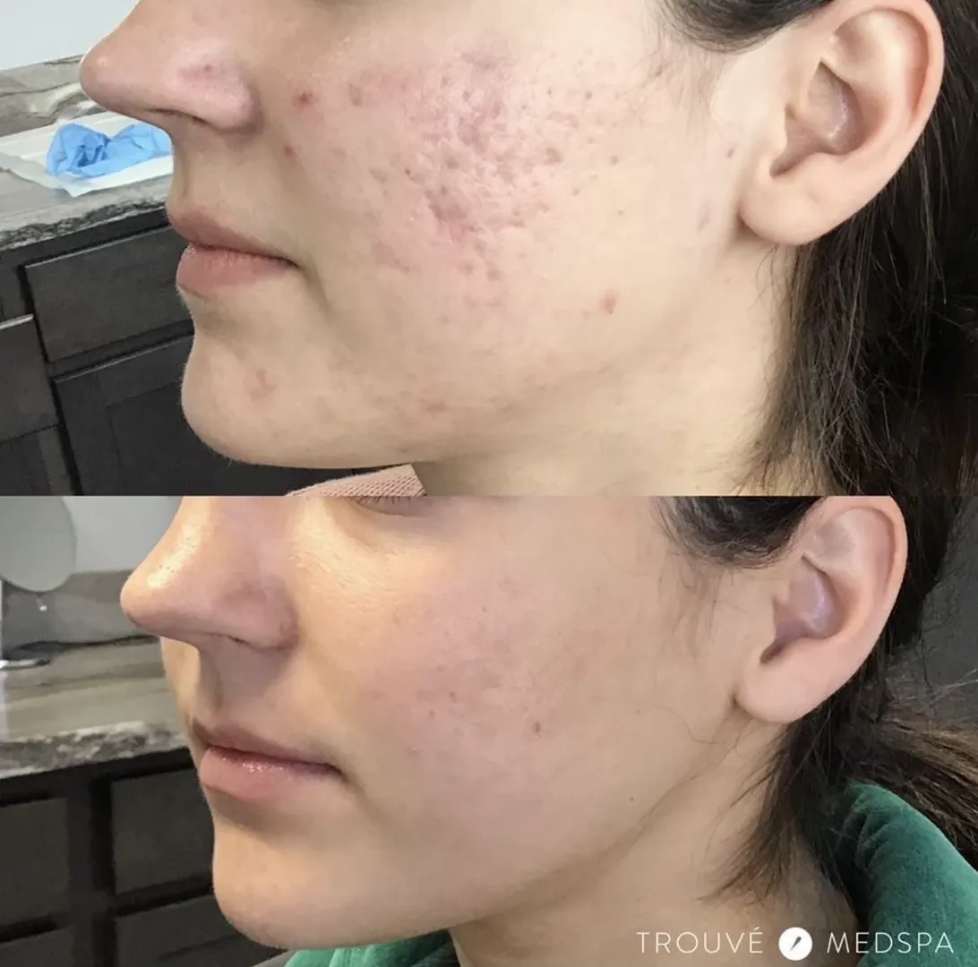 pimple scar treatment
scar removal cream
face scar removal