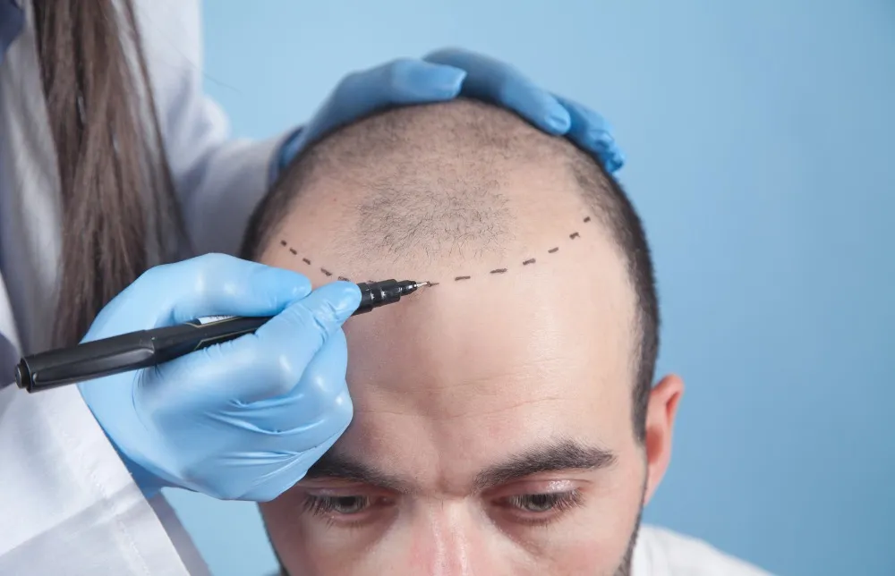 Hair Transplant Surgery in Bangalore