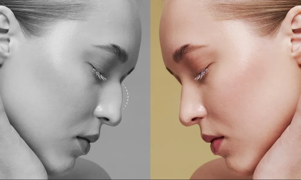 Rhinoplasty Surgery in Bangalore