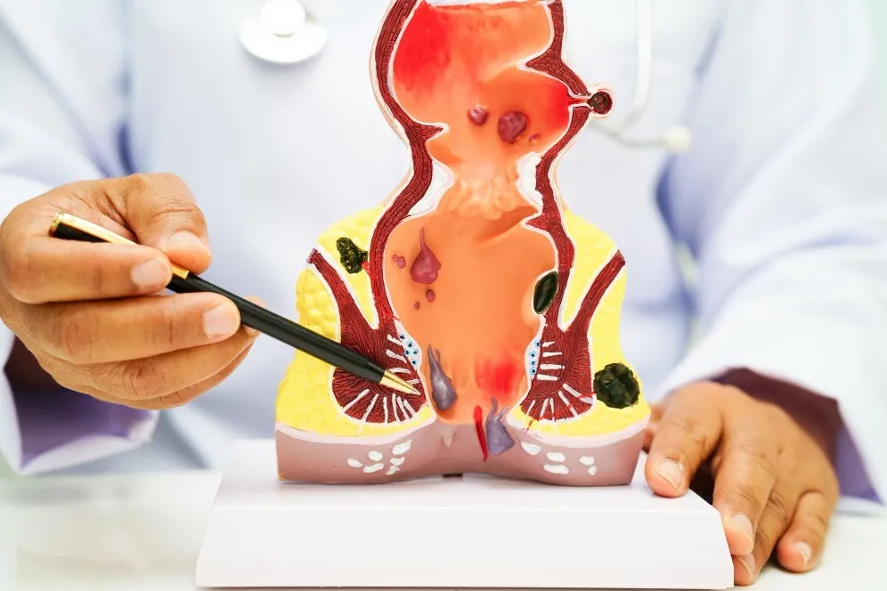 Hemorrhoid Specialist in Sion - Comfortable Care for Piles Relief