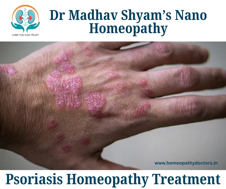 Psoriasis Homeopathy Treatment