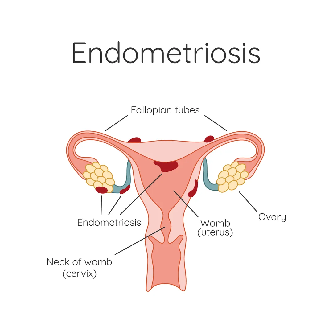 Endometriosis Doctors in Thane – Relief Through Specialized Care