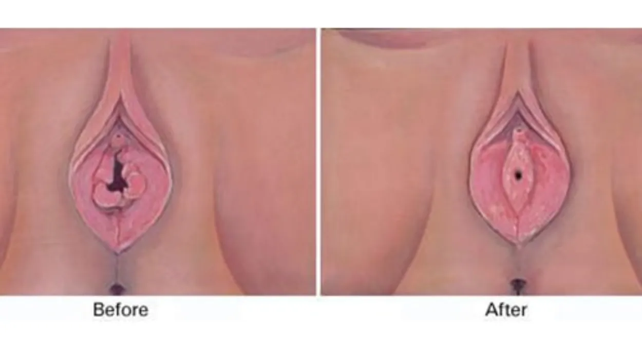 Hymenoplasty Surgery in Bangalore