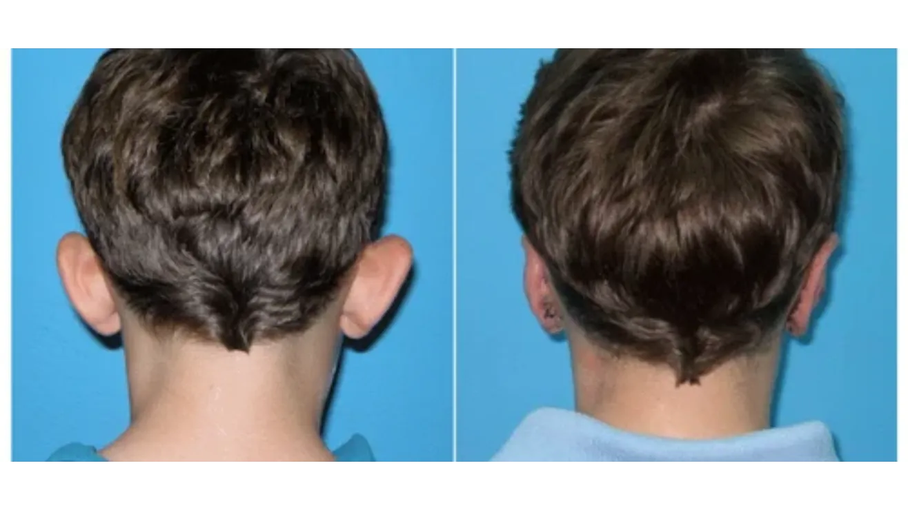 Otoplasty Sugery in Bangalore