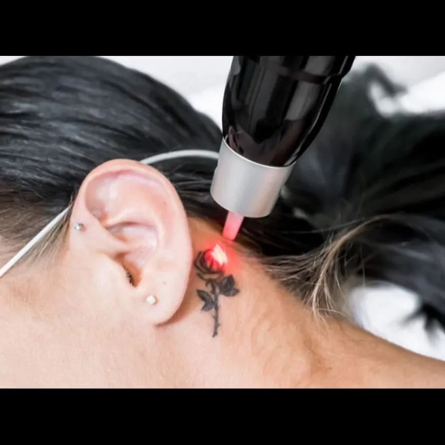 Best Tattoo Removal Treatment In Panvel