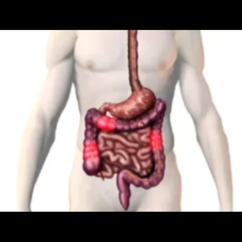 Vedolizumab Treatment for IBD in Mumbai