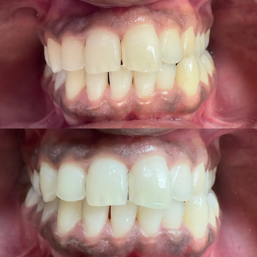 Laser Teeth Whitening in Anna Nagar Chennai Dental Mission Safe Fast and Effective Teeth Whitening