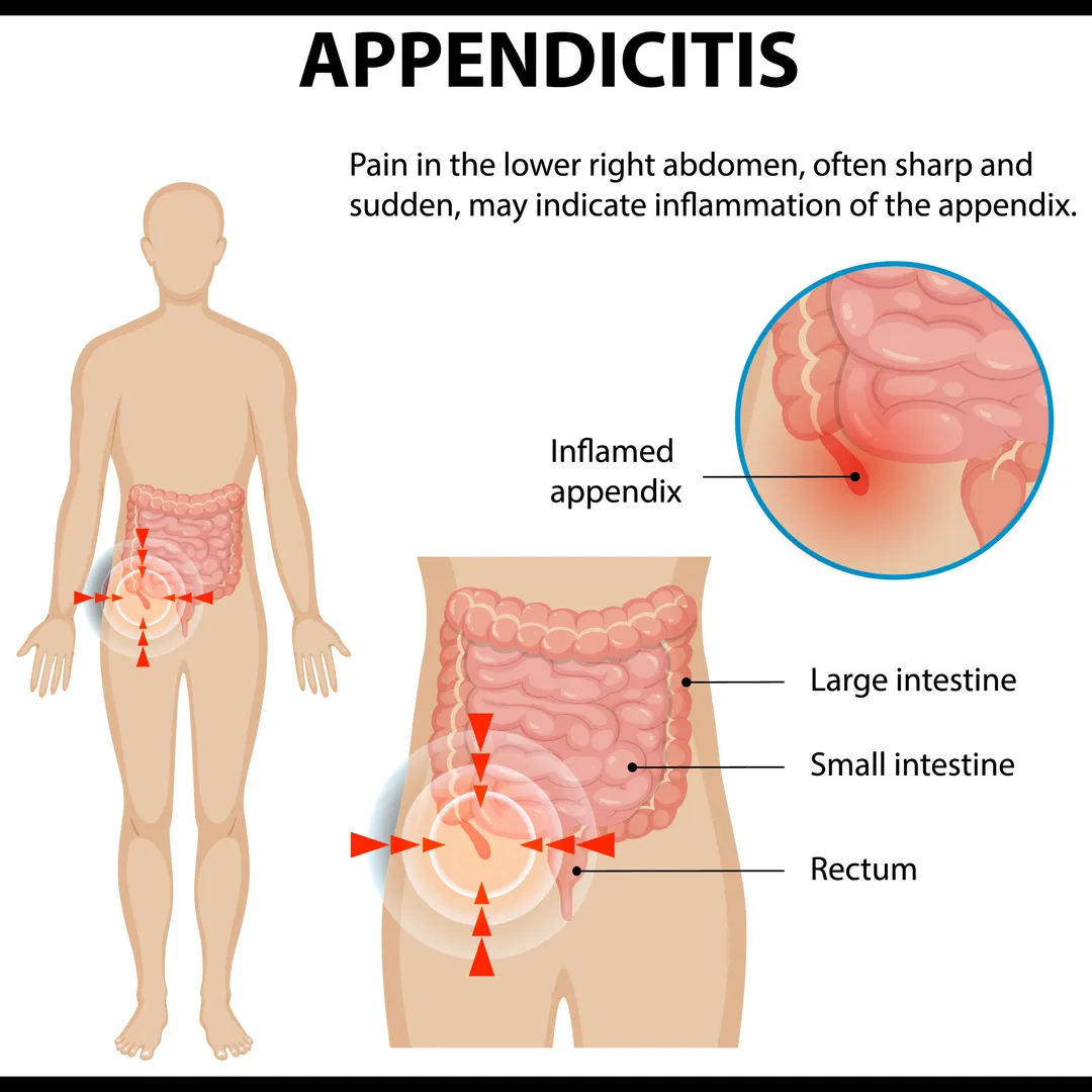 Appendicitis Treatment in Mumbai – Early Diagnosis, Better Outcomes