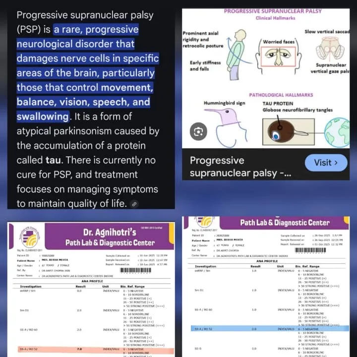 Progressive Supranuclear Palsy Responded & ANA positive to Negative by Dr Arpit Chopra Jain Aarogya...