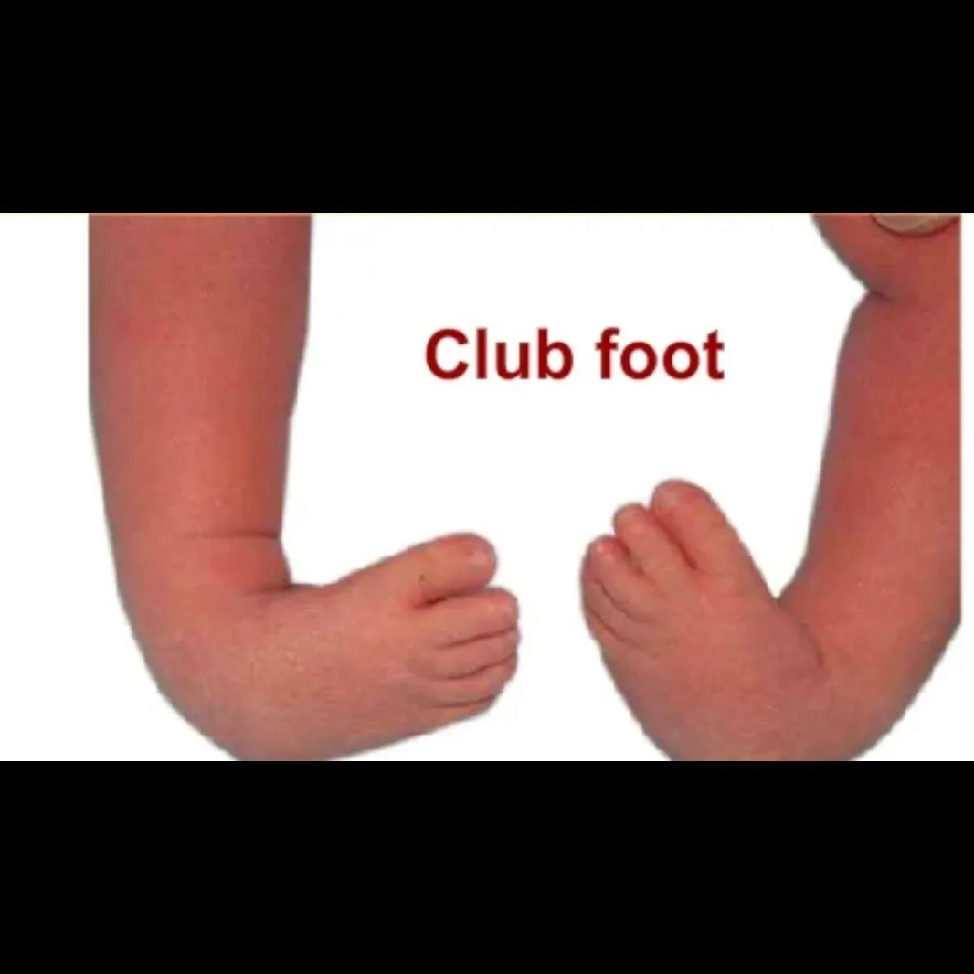 Clubfoot Treatment Doctor in Nagpur