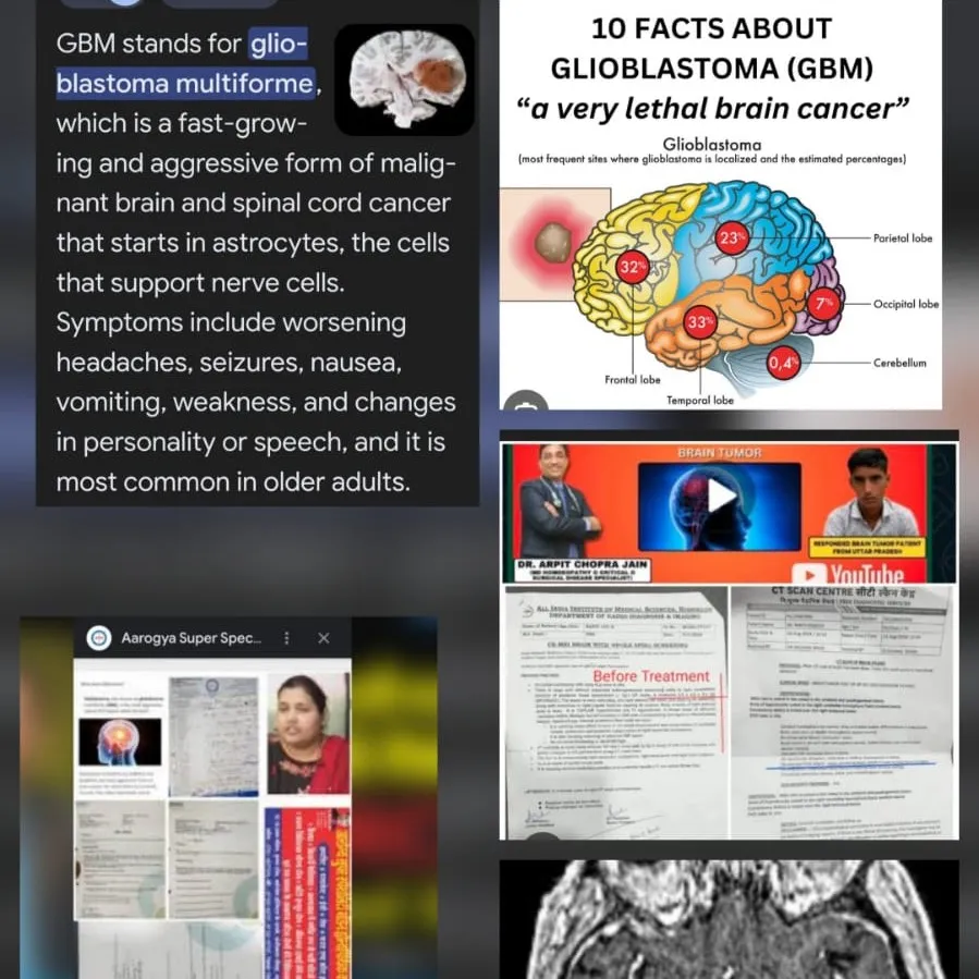 GBM Glioblastoma brain cancer & Brain tumour responded by Dr Arpit Chopra Jain Aarogya Super Special...