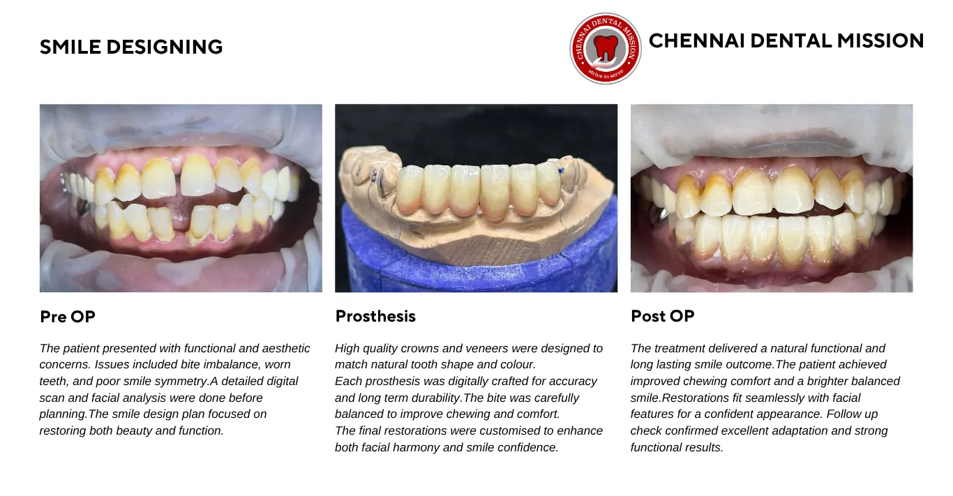 Smile Designing in Chennai | Functional and Aesthetic Smile Makeover | Chennai Dental Mission