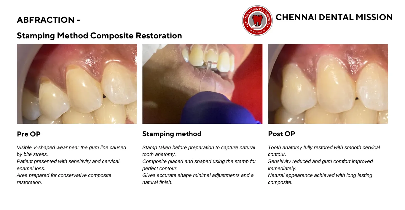 Abfraction Filling in Chennai With Stamping Method | Fast Precise and Natural Restoration