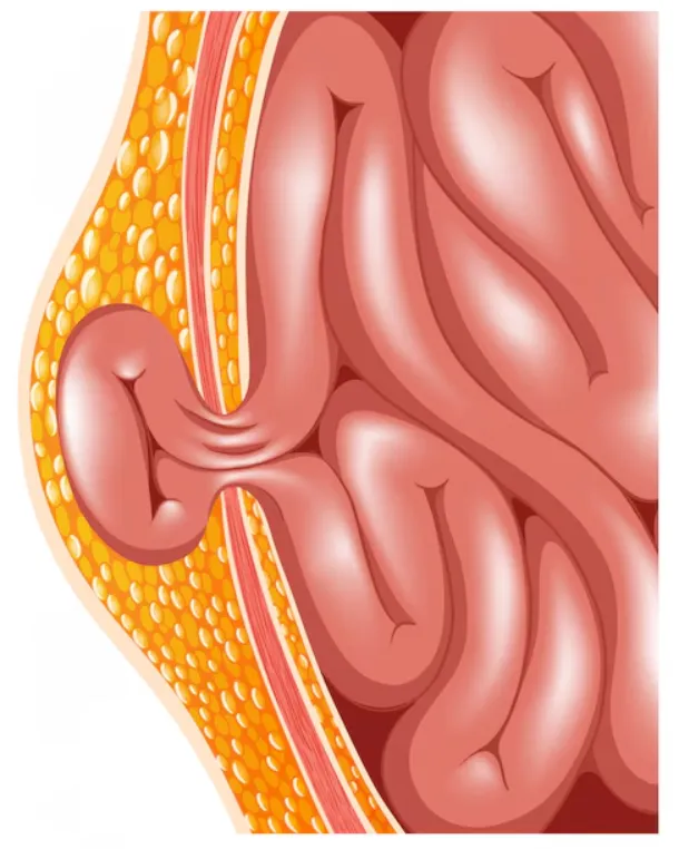 Laparoscopic Hernia Repair in Panvel