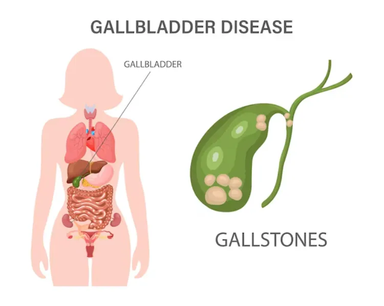 Gall Bladder Stone Disease in Mumbai – Safe and Advanced Surgical Solutions