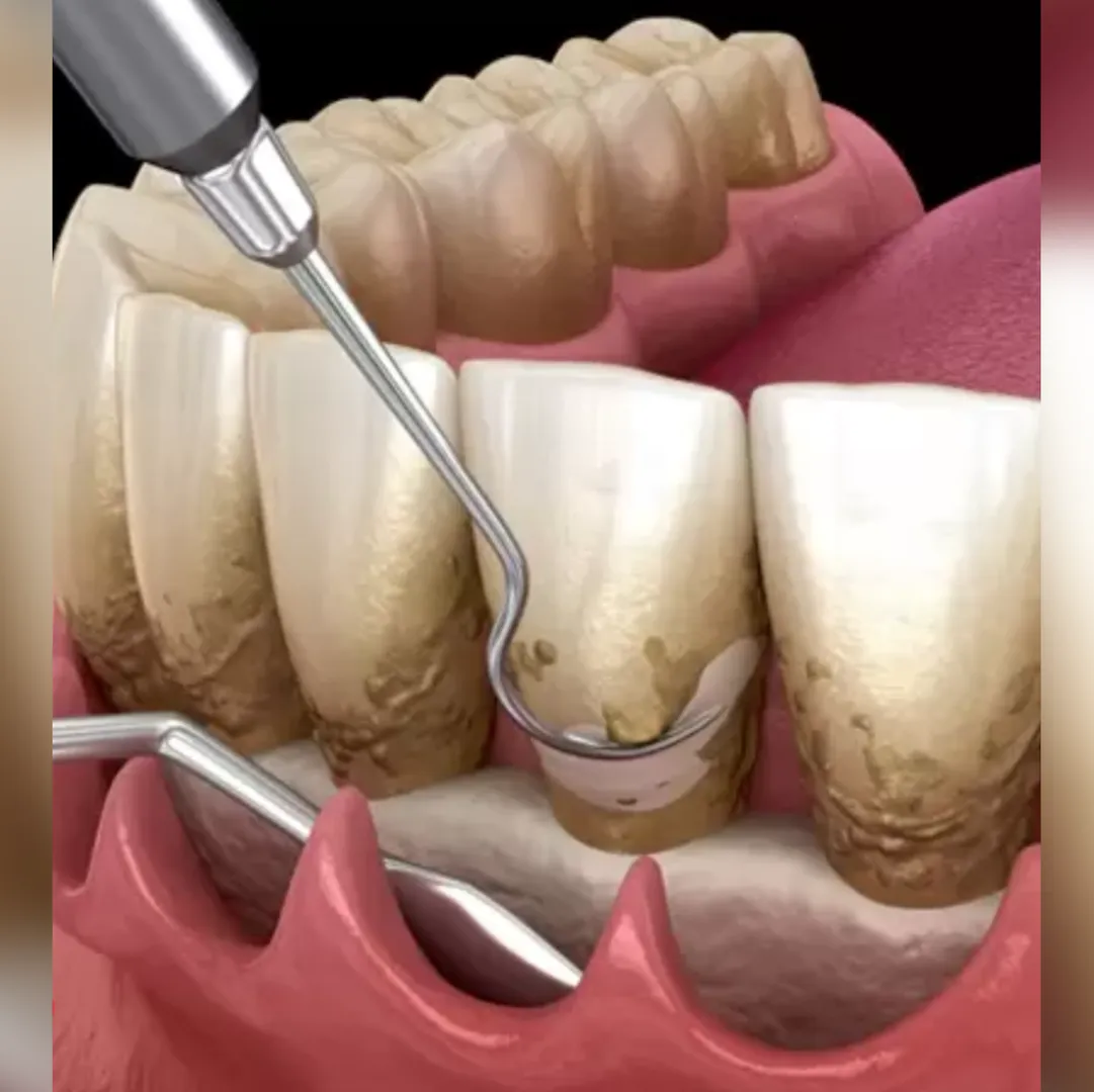Flap Surgery in Lajpat Nagar, New Delhi