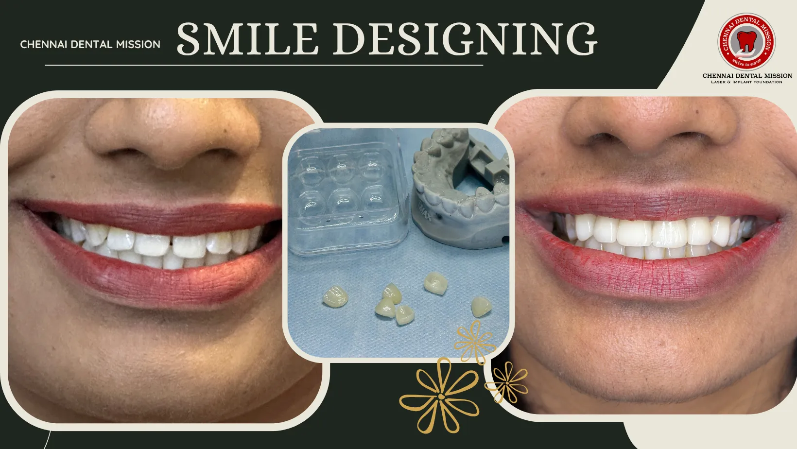 Smile Designing with Veneers in Chennai – Restore Your Natural Smile & Confidence