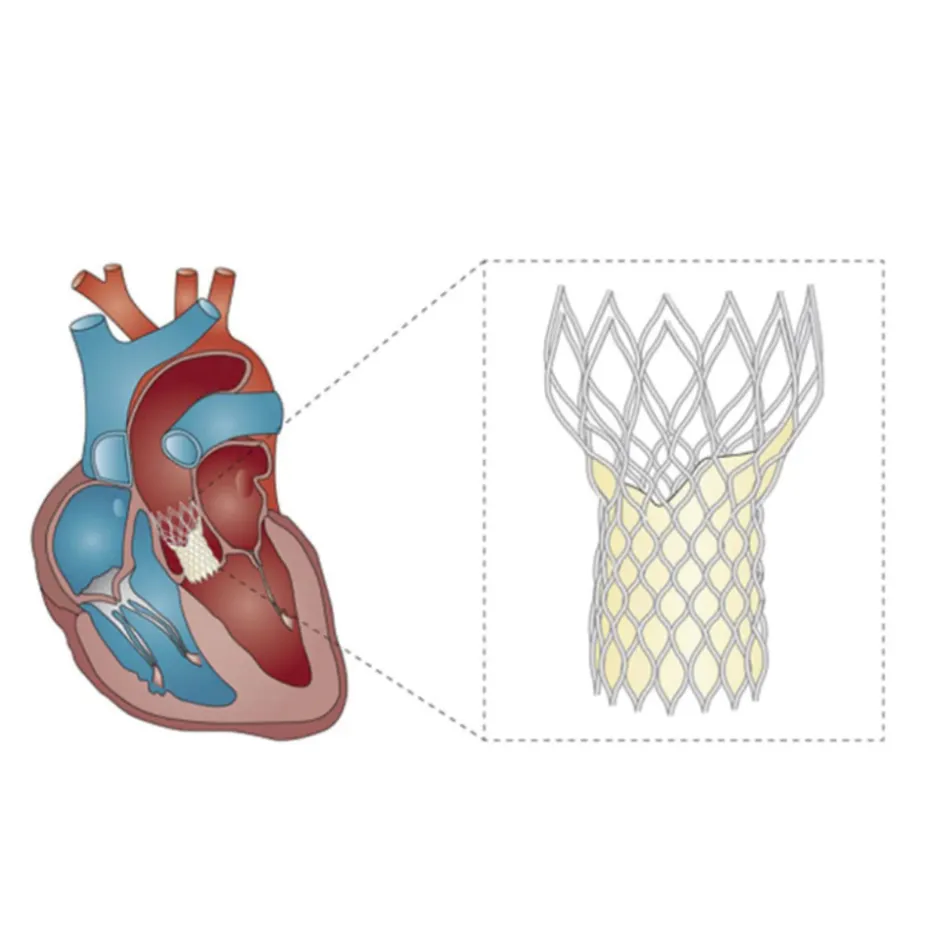 TAVI for Aortic Stenosis in Chennai