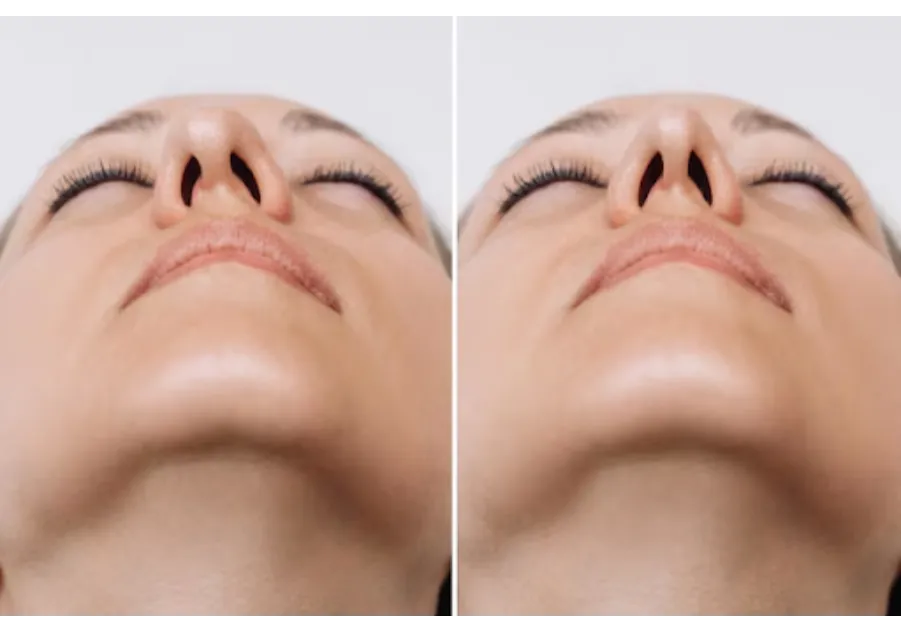 Septoplasty Surgery in Bangalore