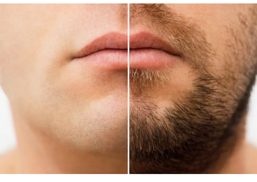 Moustache Transplantation in Bangalore