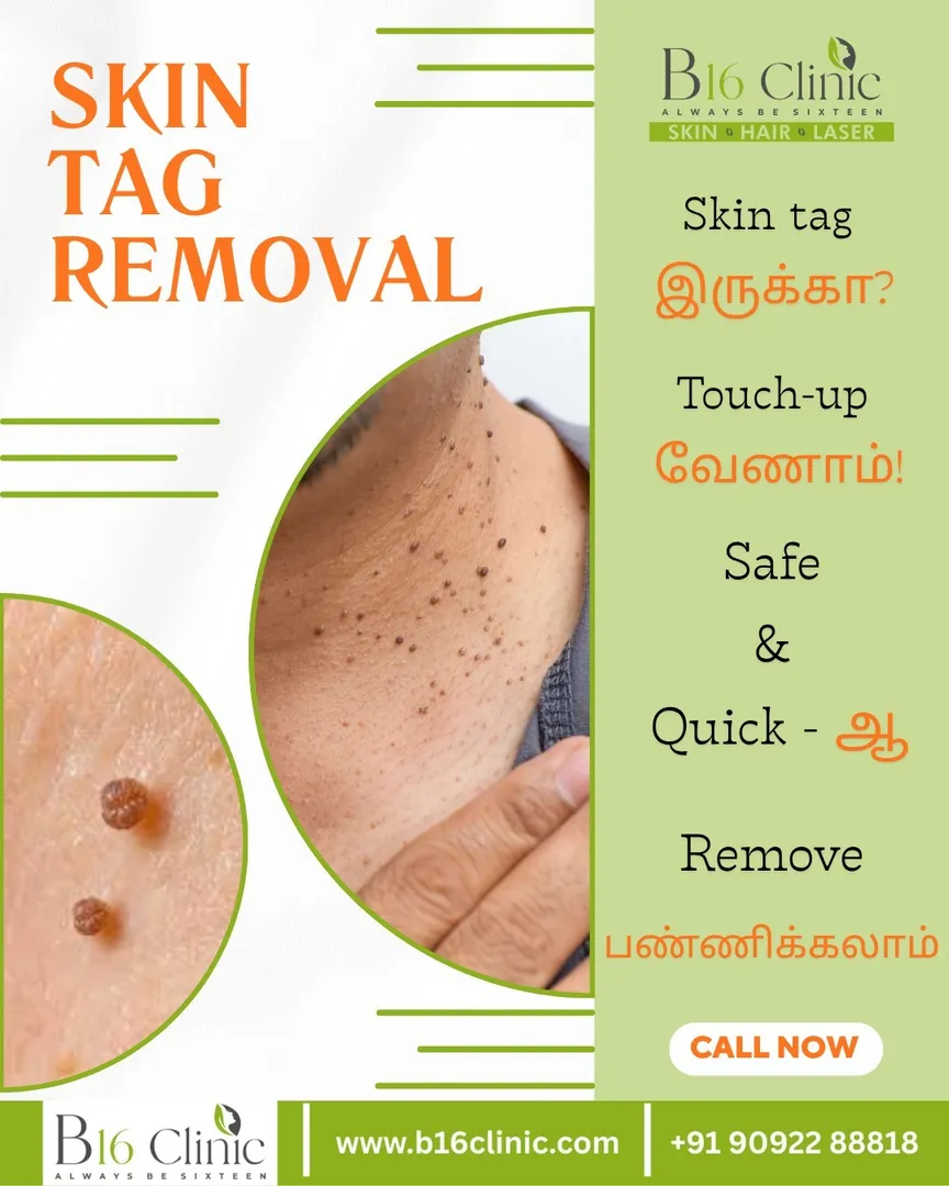 Skin Tag Removal treatment in Coimbatore
