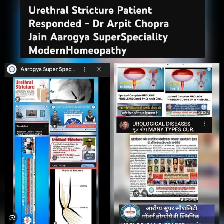 Urethral Stricture Patient Cured & Responded - Dr Arpit Chopra Jain Aarogya Super Speciality Modern ...