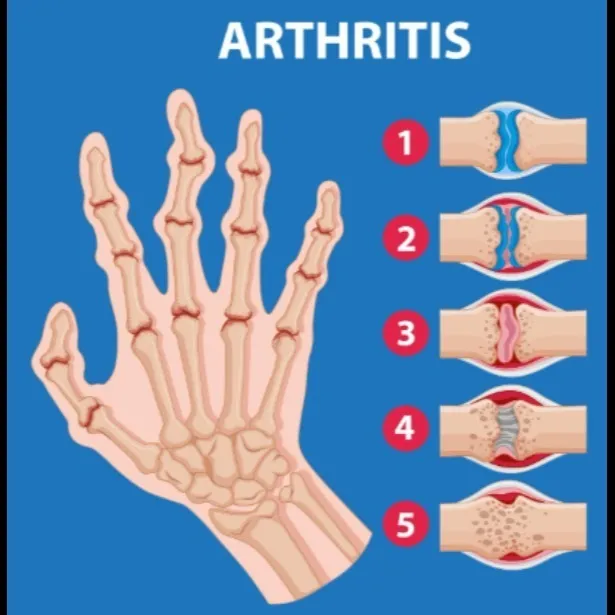 Arthritis Doctor in Nagpur – suyog hospital nagpur