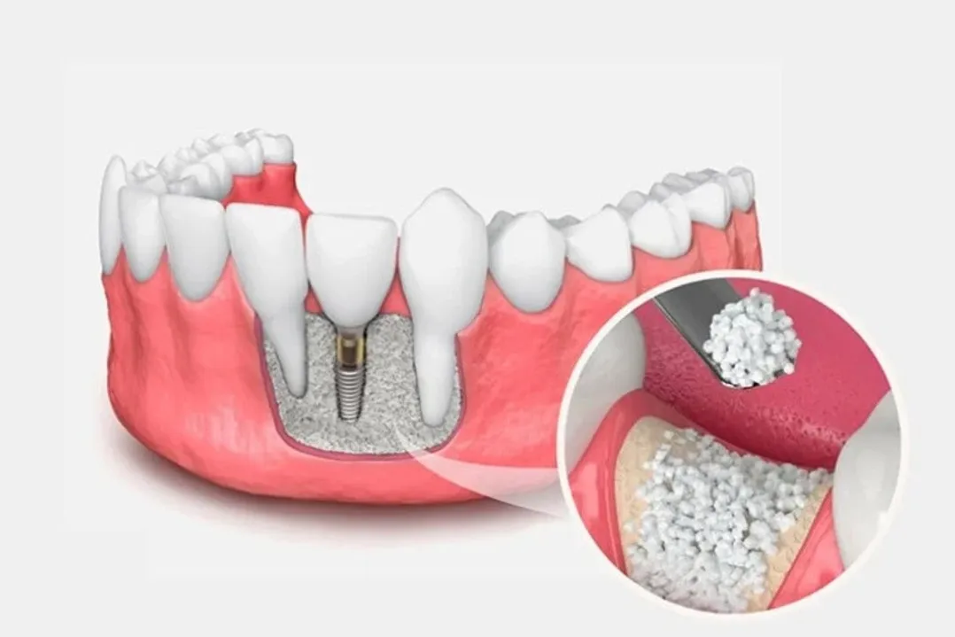 Advanced Bone Grafting & Tissue Regeneration in South Delhi