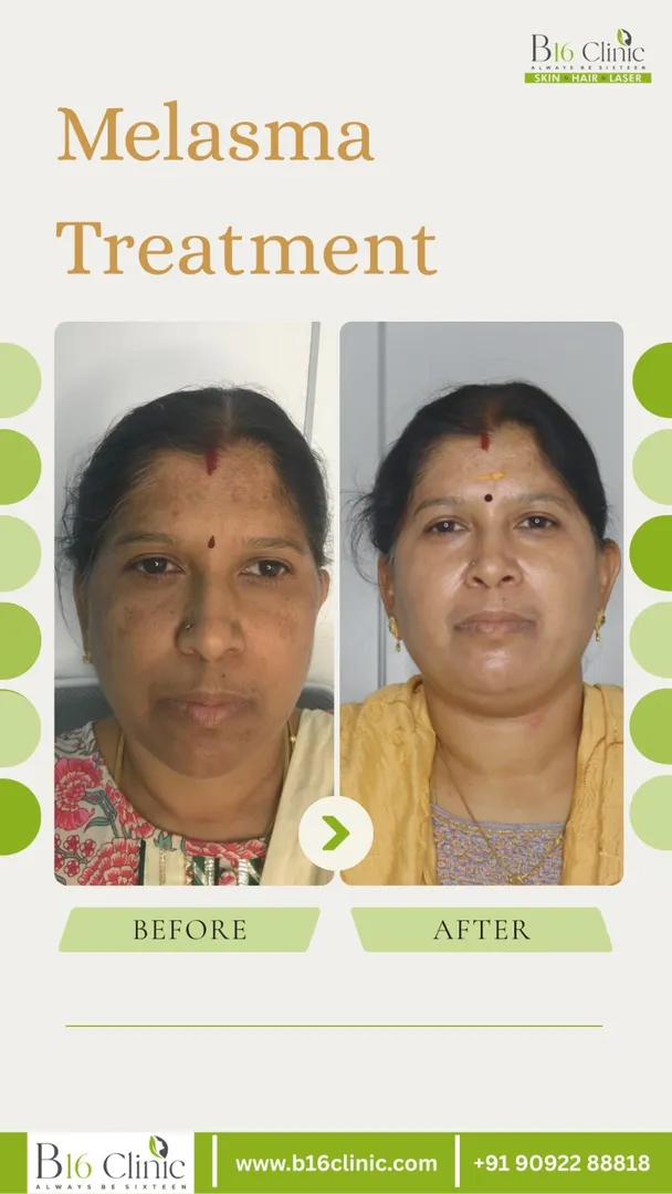 Melasma Treatment clinic in coimbatore