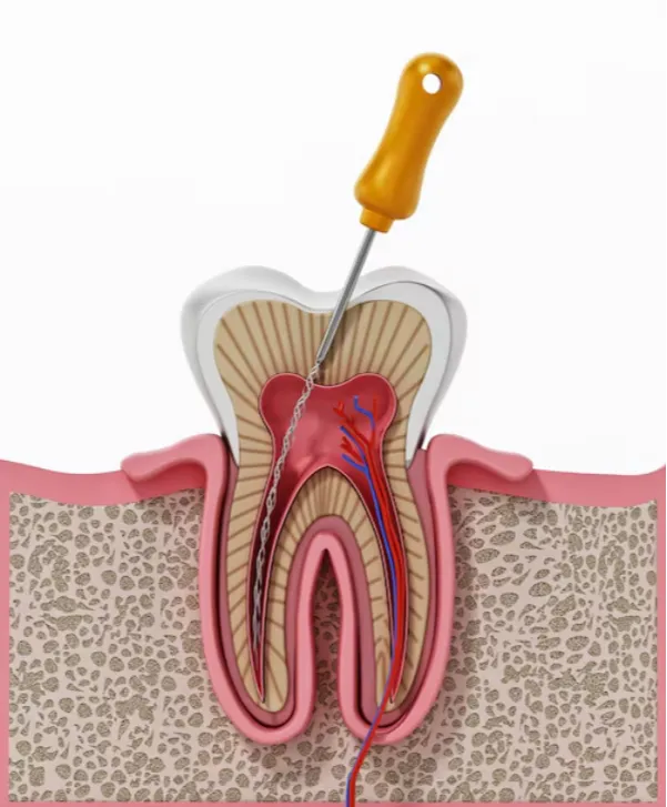 Endodontic Treatments in Madhura Nagar