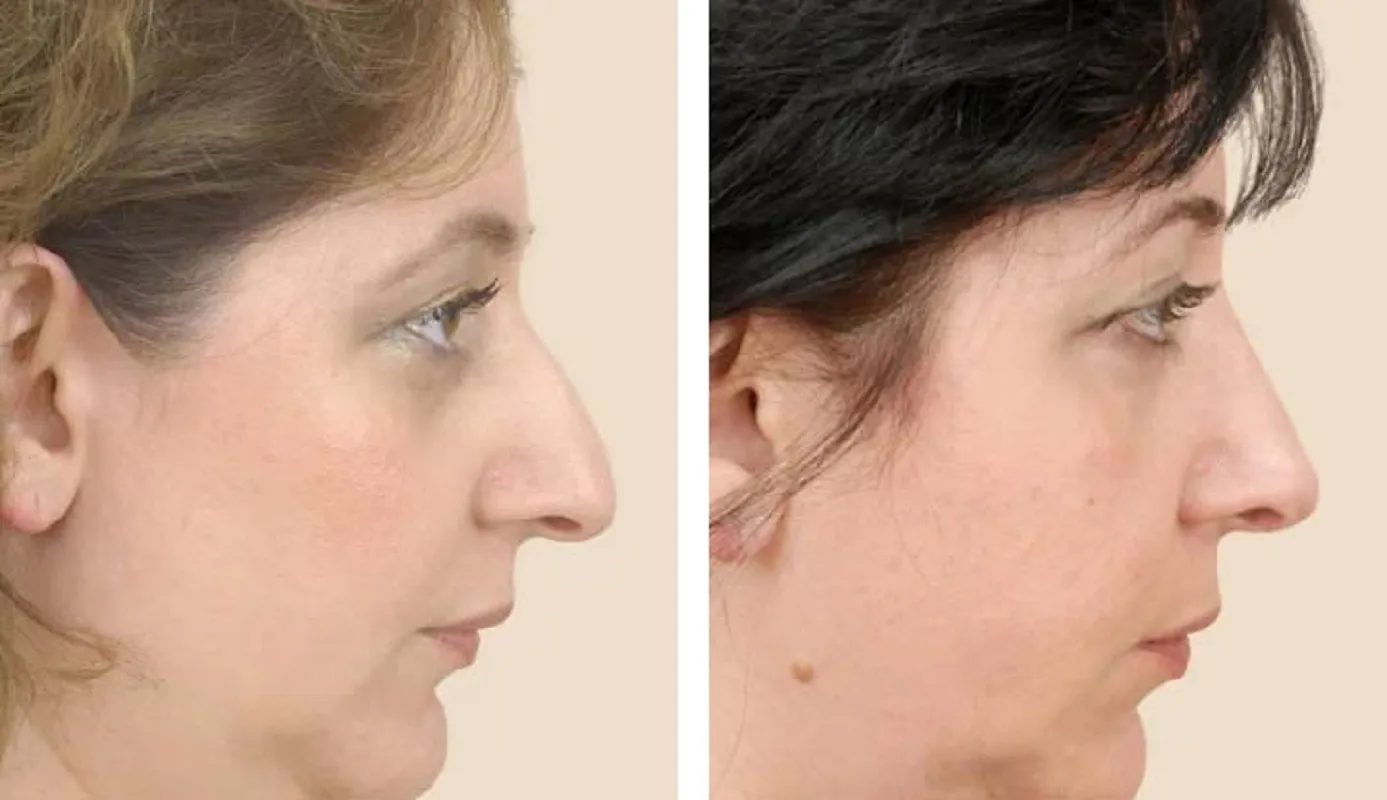 Rhinoplasty in Delhi