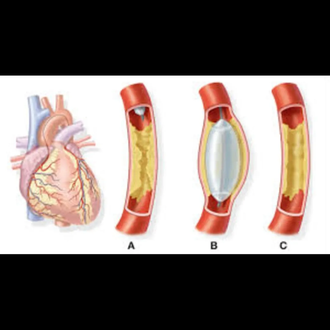 Angiography in Pune