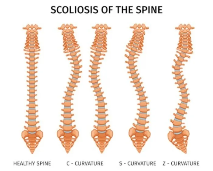 Scoliosis Specialist in Nagpur – SUYOG HOSPITAL NAGPUR