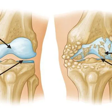 Best Knee Treatment Center in Vartak Nagar