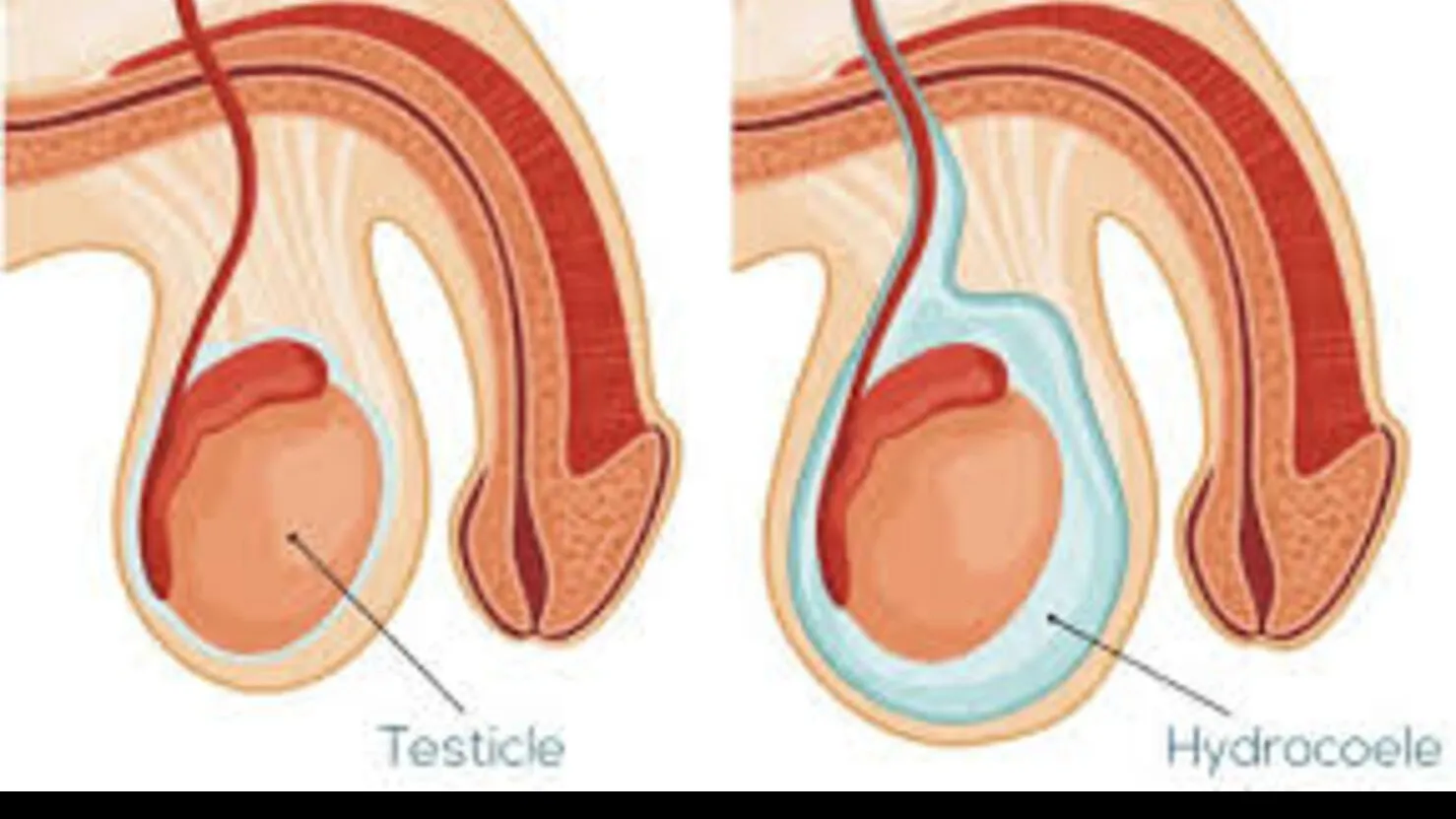 Hydrocele Surgery in Mumbai – Safe and Effective Treatment for Lasting Relief