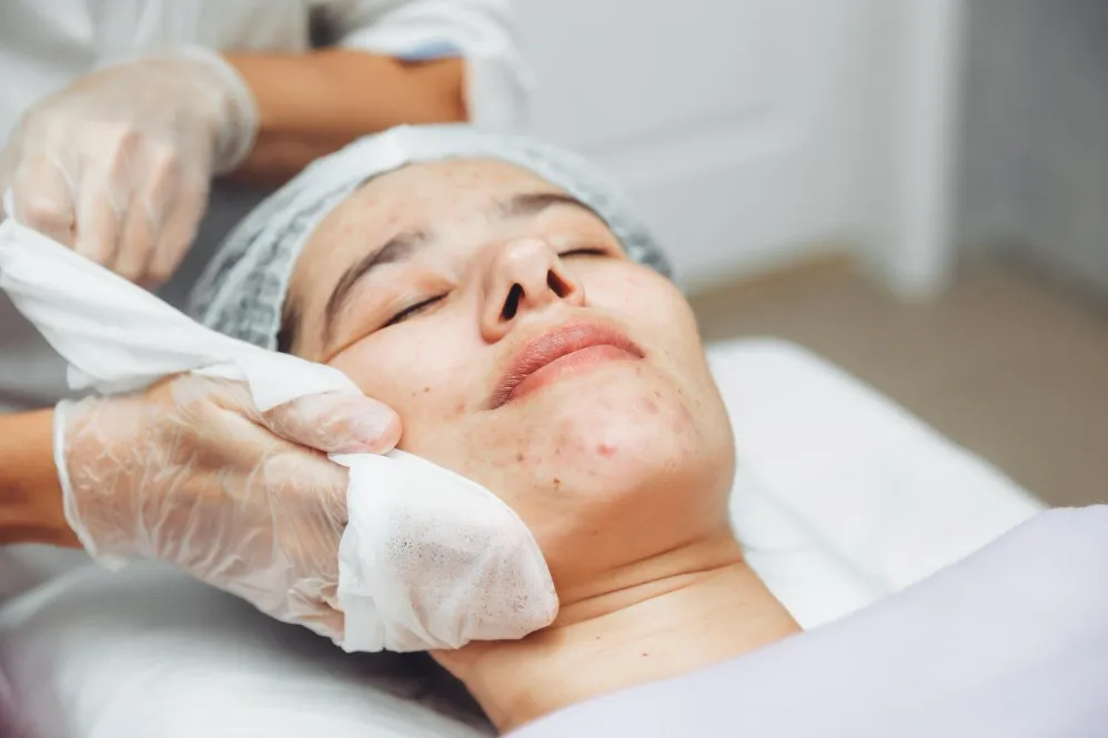 Acne and Acne Scar Treatment Clinic in Pune – Clear Skin with Expert Care at Spire Hospital