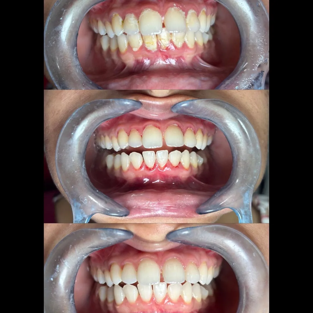Transformation After Teeth Cleaning and Whitening – What Patients in Thane & Mulund Can Expect