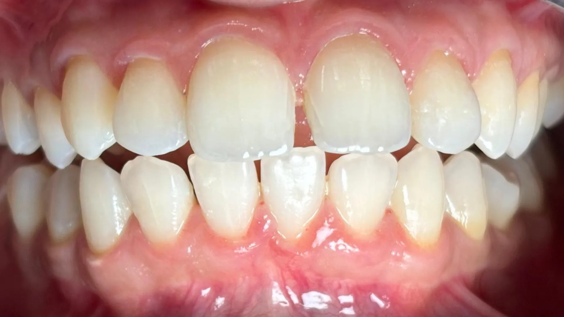Is Teeth Whitening Permanent?