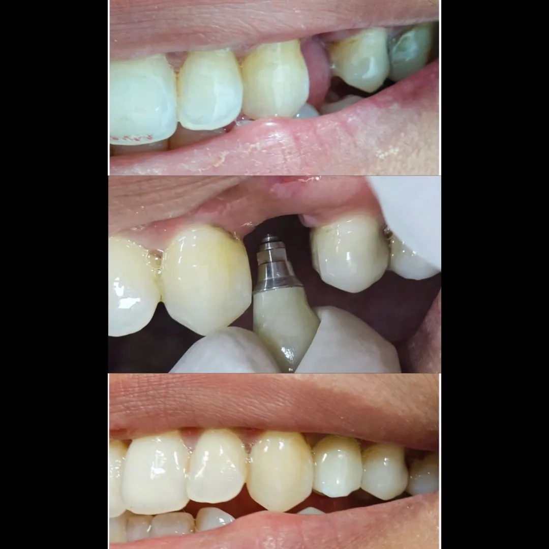 Does an Implant Tooth Feel Just Like Natural Teeth?