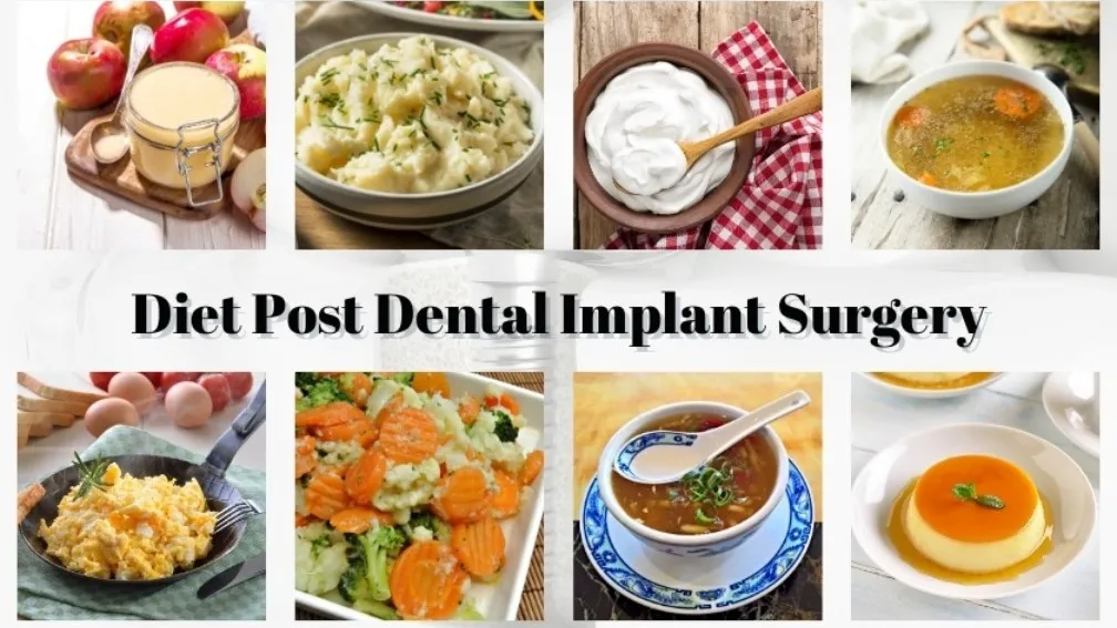 Can I Eat Everything After a Dental Implant?