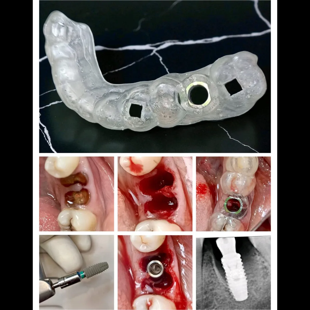 How Does a Surgical Guide Help in Dental Implant Surgery?