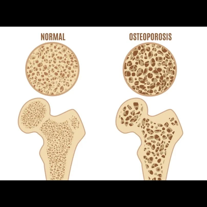 Osteoporosis Management in Noida – Strengthening Bones for Life