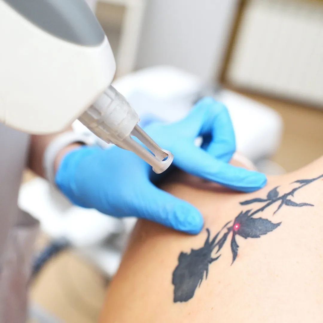 Best tattoo removal treatment in Koparkhairane